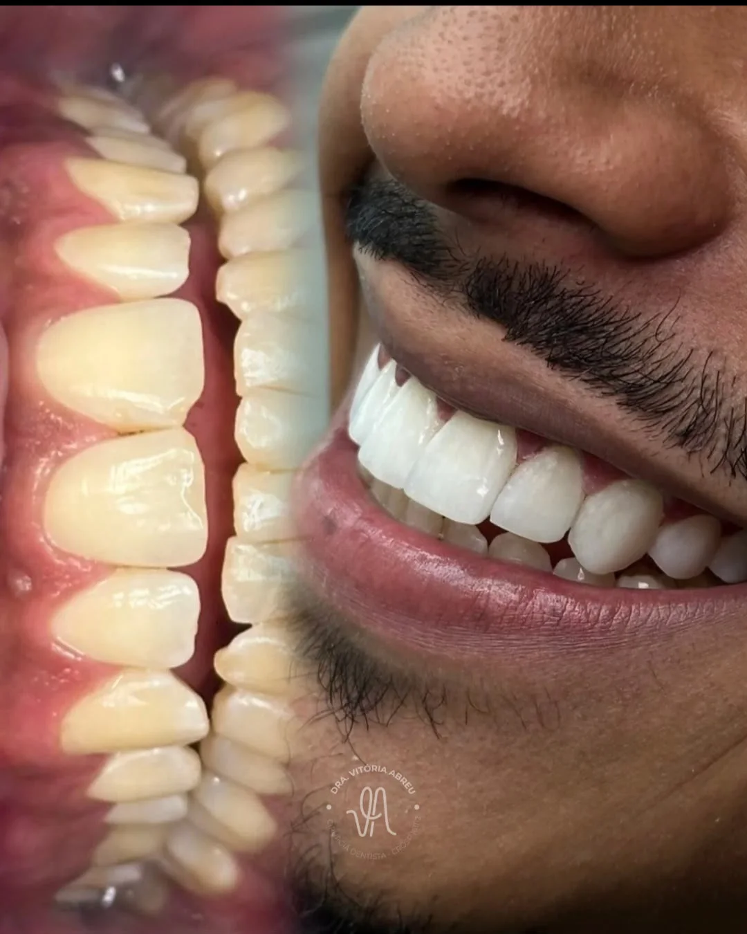 Caso clínico odontológico autorizado com resultado do sorriso