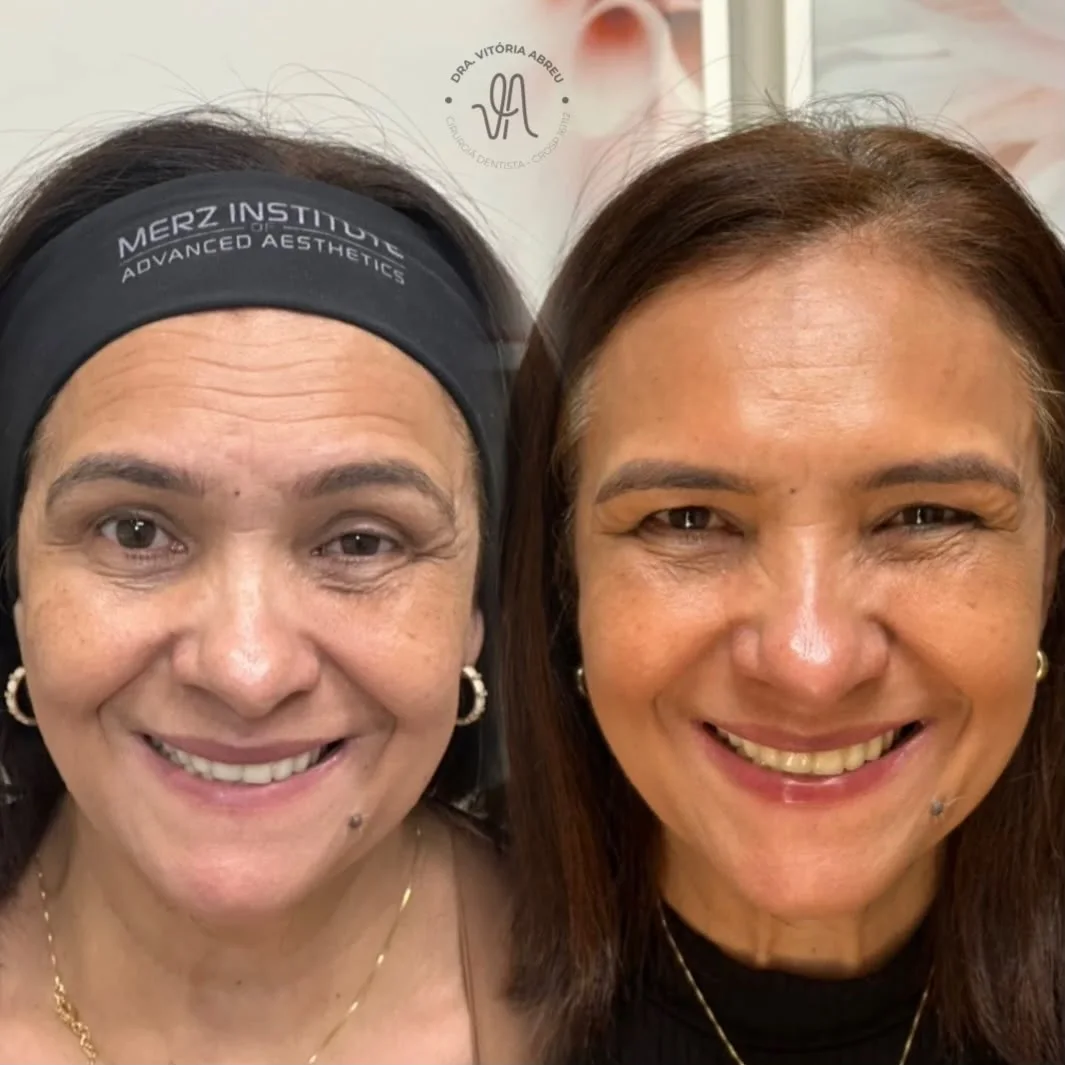 Comparativo autorizado de resultado em estética facial