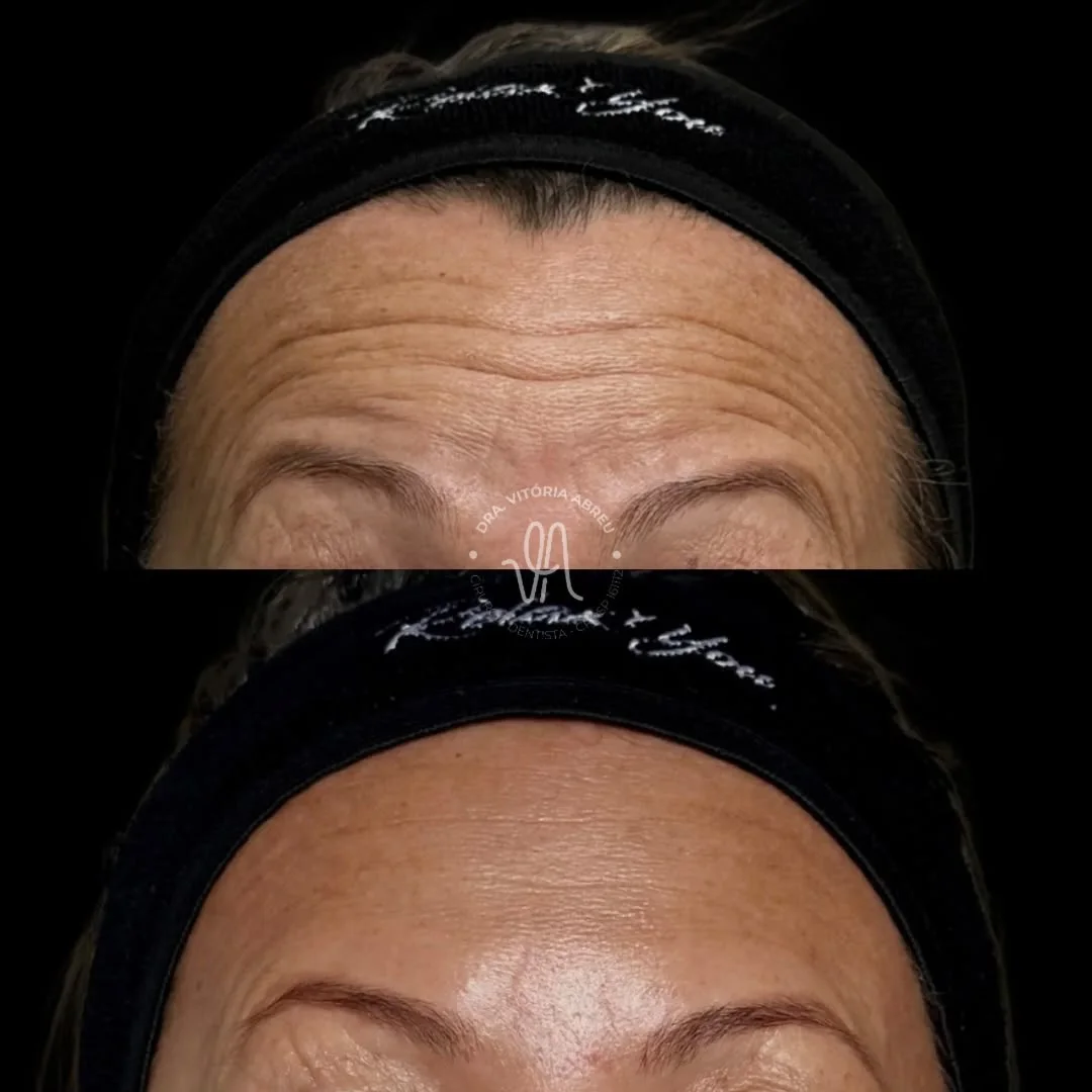 Comparativo autorizado de linhas da testa antes e depois
