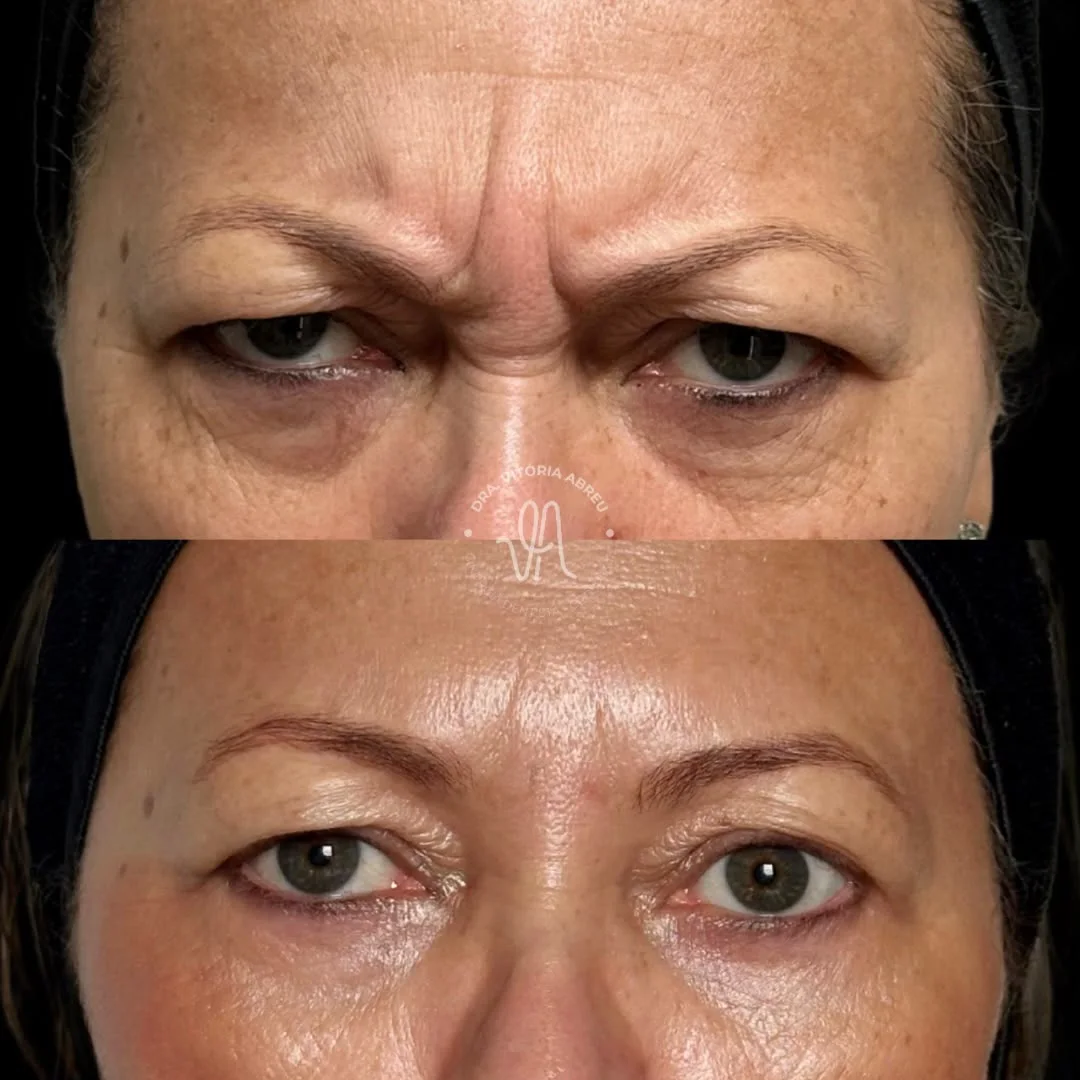 Comparativo facial autorizado antes e depois