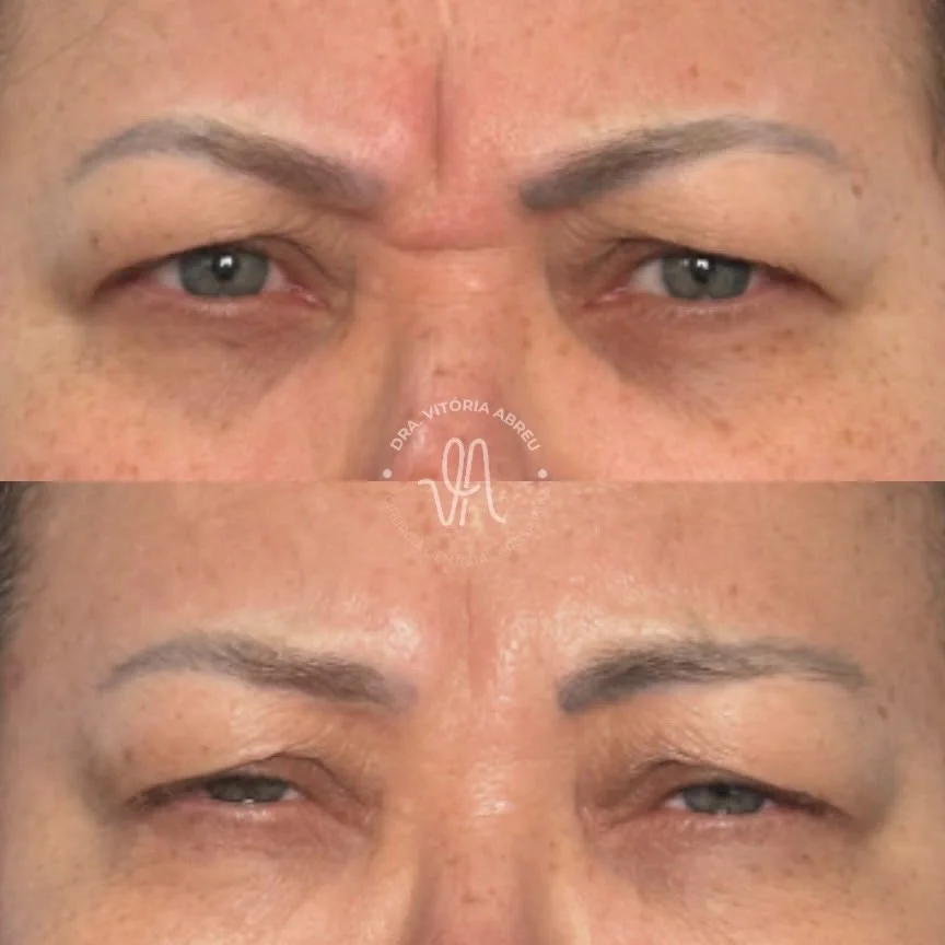 Comparativo autorizado de resultado facial